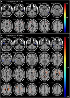 Aberrant amplitude of low-frequency fluctuations in different frequency bands and changes after one-night positive airway pressure treatment in severe obstructive sleep apnea